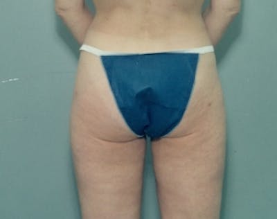 Liposuction and Smartlipo Before & After Gallery - Patient 5946510 - Image 2