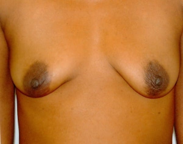 Breast Augmentation Before & After Gallery - Patient 5946558 - Image 1