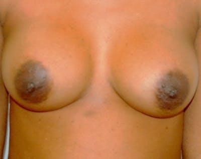 Breast Augmentation Before & After Gallery - Patient 5946558 - Image 2