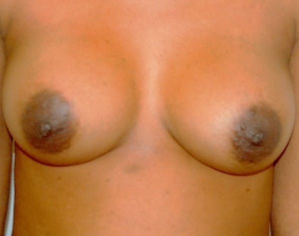 Breast Augmentation Before & After Gallery - Patient 5946558 - Image 2