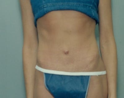 Tummy Tuck Before & After Gallery - Patient 5946568 - Image 2