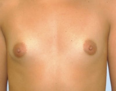Breast Augmentation Before & After Gallery - Patient 5946595 - Image 1