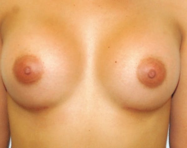 Breast Augmentation Before & After Gallery - Patient 5946595 - Image 2