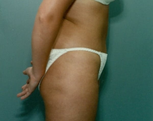 Liposuction and Smartlipo Gallery - Patient 5946598 - Image 2
