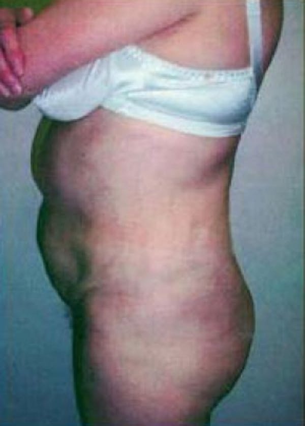 Brazilian Butt Lift Gallery - Patient 5946599 - Image 2