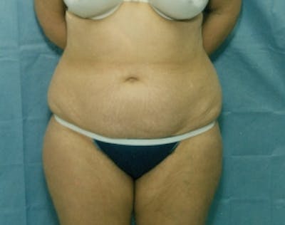 Liposuction and Smartlipo Before & After Gallery - Patient 5946606 - Image 1