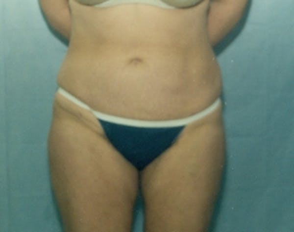 Liposuction and Smartlipo Gallery - Patient 5946606 - Image 2
