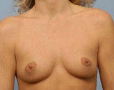 Breast Augmentation Before & After Gallery - Patient 5946621 - Image 1