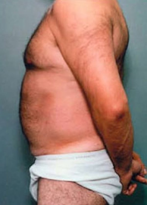 Liposuction and Smartlipo Before & After Gallery - Patient 5946642 - Image 2