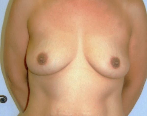 Breast Augmentation Before & After Gallery - Patient 5946670 - Image 1