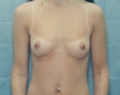 Breast Augmentation Before & After Gallery - Patient 5946685 - Image 1