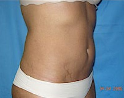 Liposuction and Smartlipo Gallery - Patient 5946684 - Image 2