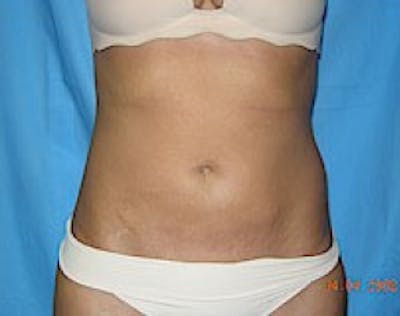 Liposuction and Smartlipo Before & After Gallery - Patient 5946691 - Image 2