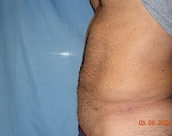 Liposuction and Smartlipo Before & After Gallery - Patient 5946697 - Image 2