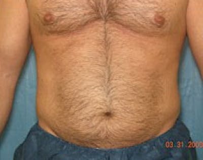 Liposuction and Smartlipo Before & After Gallery - Patient 5946712 - Image 1