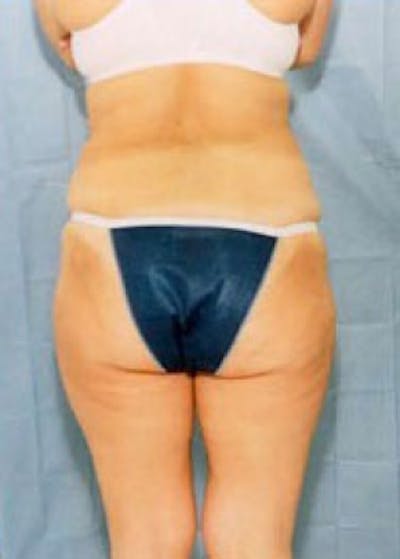 Liposuction and Smartlipo Gallery - Patient 5946722 - Image 2
