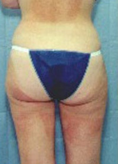 Liposuction and Smartlipo Before & After Gallery - Patient 5946736 - Image 2