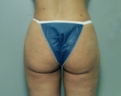 Liposuction and Smartlipo Before & After Gallery - Patient 5946750 - Image 2