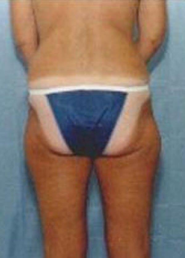Liposuction and Smartlipo Before & After Gallery - Patient 5946757 - Image 1