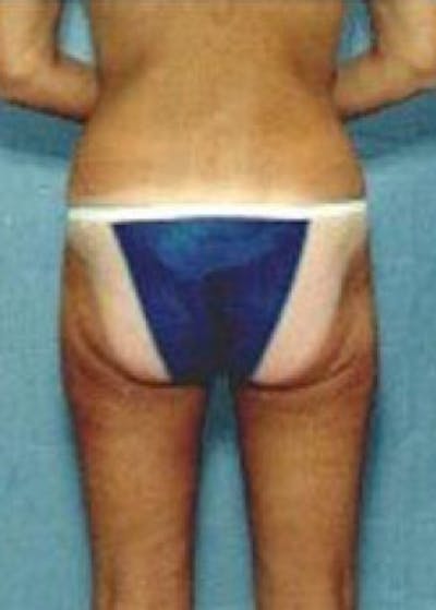 Liposuction and Smartlipo Gallery - Patient 5946757 - Image 2