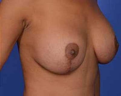 Breast Lift with Implants Before & After Gallery - Patient 5947400 - Image 2