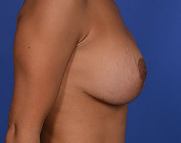 Breast Lift with Implants Before & After Gallery - Patient 5947400 - Image 4