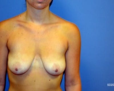 Breast Lift with Implants Before & After Gallery - Patient 5947440 - Image 1