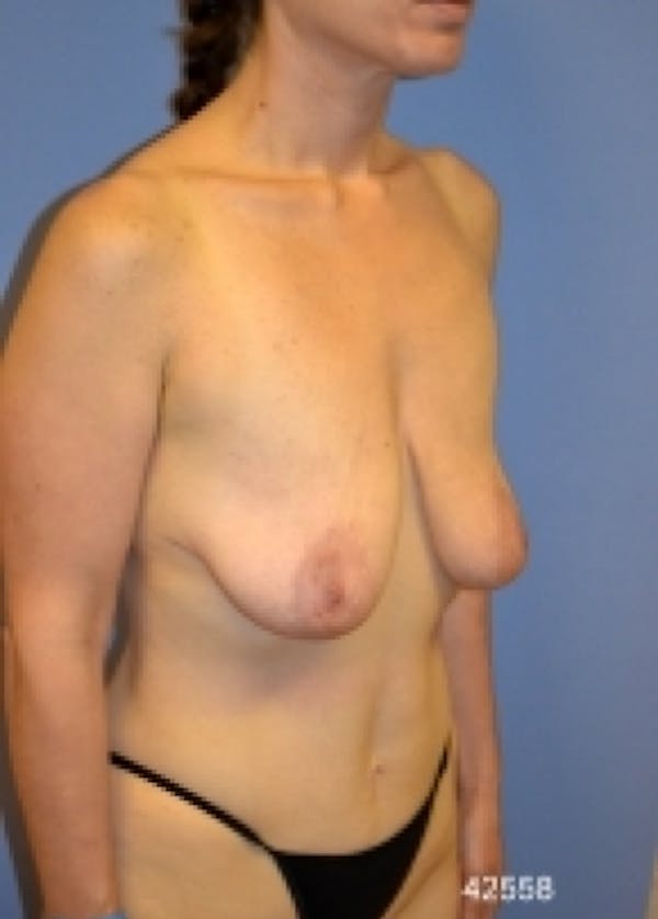 Breast Lift with Implants Before & After Gallery - Patient 5947536 - Image 3