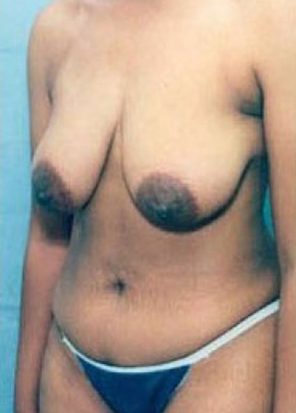 Breast Lift with Implants Before & After Gallery - Patient 5947587 - Image 1