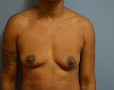 Breast Lift with Implants Before & After Gallery - Patient 5947622 - Image 1