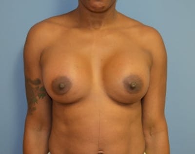 Breast Lift with Implants Before & After Gallery - Patient 5947622 - Image 2