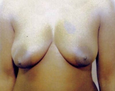 Breast Lift with Implants Before & After Gallery - Patient 5947624 - Image 1