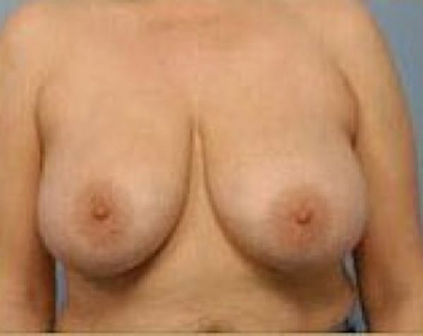 Breast Lift and Reduction Before & After Gallery - Patient 5950915 - Image 1