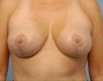 Breast Lift and Reduction Before & After Gallery - Patient 5950915 - Image 2