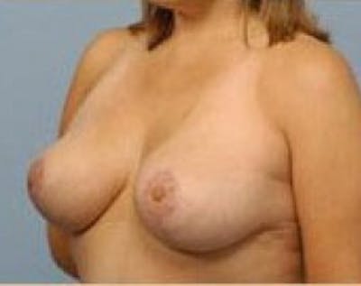 Breast Lift and Reduction Before & After Gallery - Patient 5950915 - Image 4