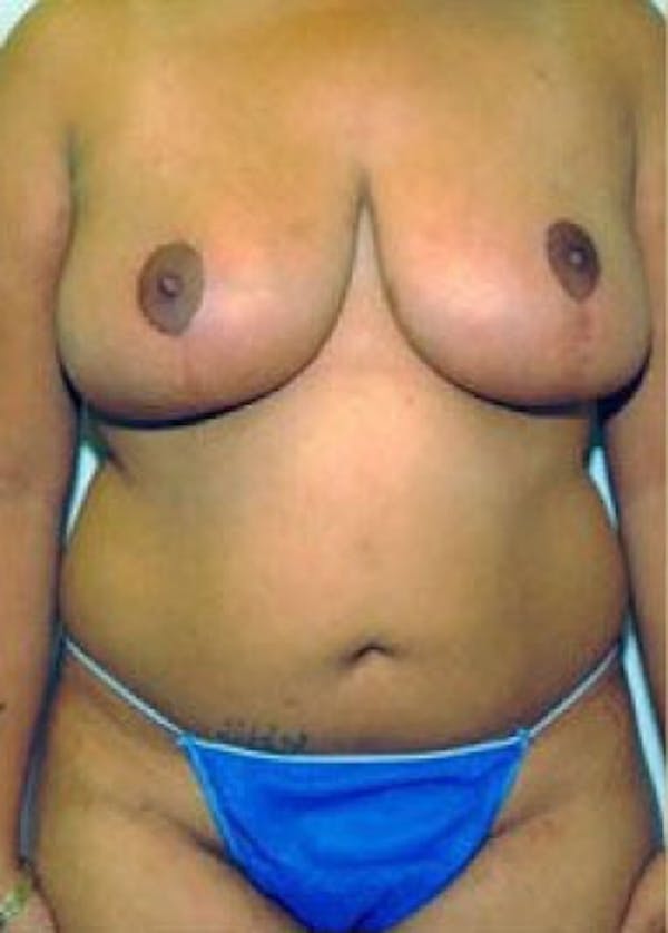 Breast Lift and Reduction Before & After Gallery - Patient 5950919 - Image 2