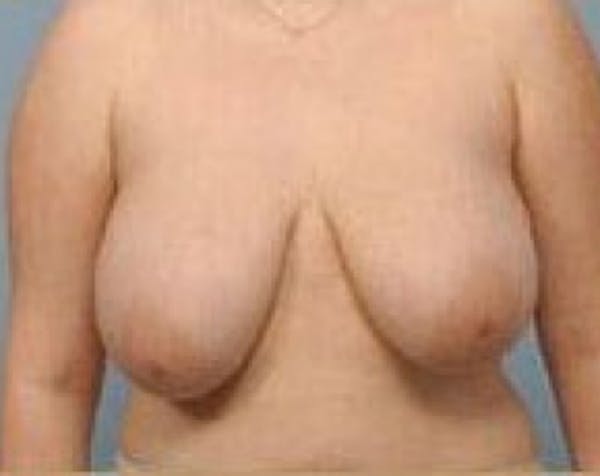 Breast Lift and Reduction Before & After Gallery - Patient 5950932 - Image 1