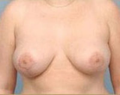 Breast Lift and Reduction Before & After Gallery - Patient 5950932 - Image 2