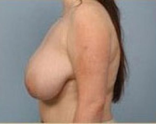 Breast Lift and Reduction Before & After Gallery - Patient 5950932 - Image 3