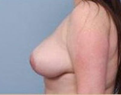 Breast Lift and Reduction Before & After Gallery - Patient 5950932 - Image 4