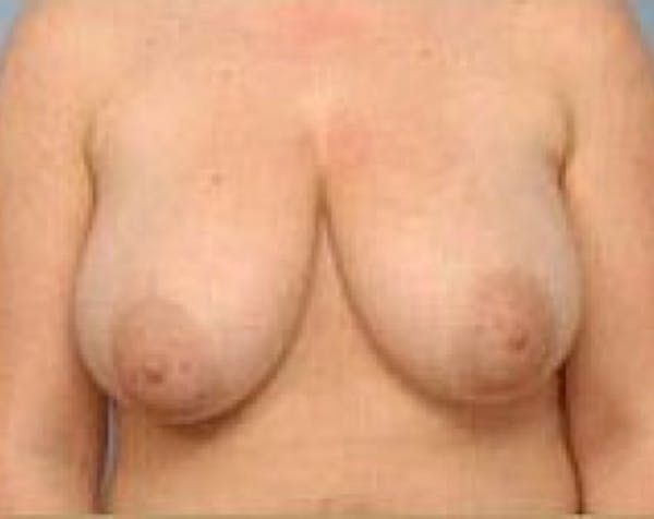 Breast Lift and Reduction Before & After Gallery - Patient 5950935 - Image 1