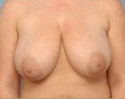 Breast Lift and Reduction Before & After Gallery - Patient 5950935 - Image 1