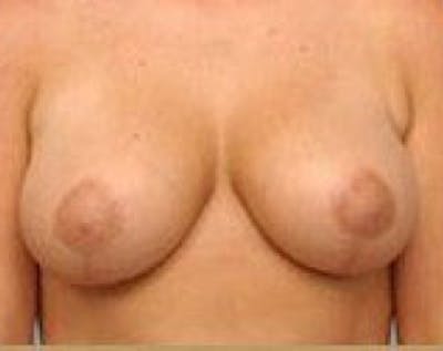 Breast Lift and Reduction Before & After Gallery - Patient 5950935 - Image 2