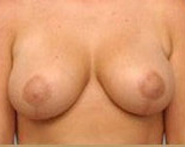 Breast Lift and Reduction Before & After Gallery - Patient 5950935 - Image 2