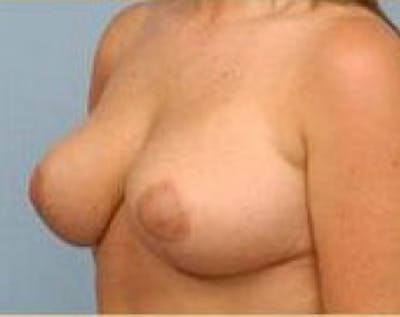 Breast Lift and Reduction Before & After Gallery - Patient 5950935 - Image 4