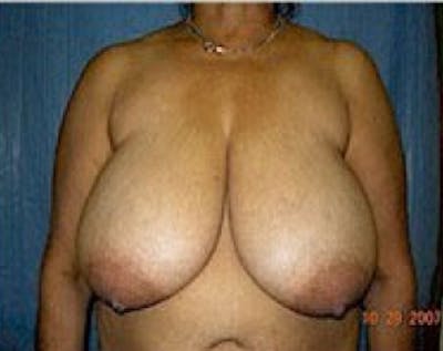 Breast Lift and Reduction Before & After Gallery - Patient 5950936 - Image 1