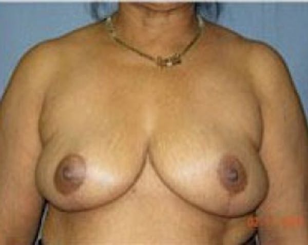 Breast Lift and Reduction Before & After Gallery - Patient 5950936 - Image 2