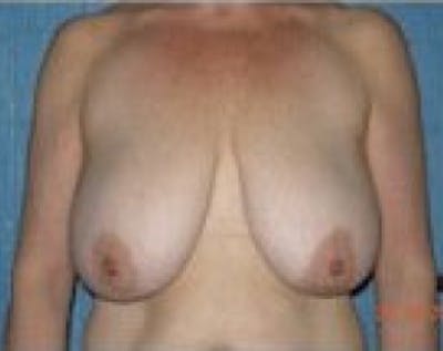 Breast Lift and Reduction Before & After Gallery - Patient 5950950 - Image 1