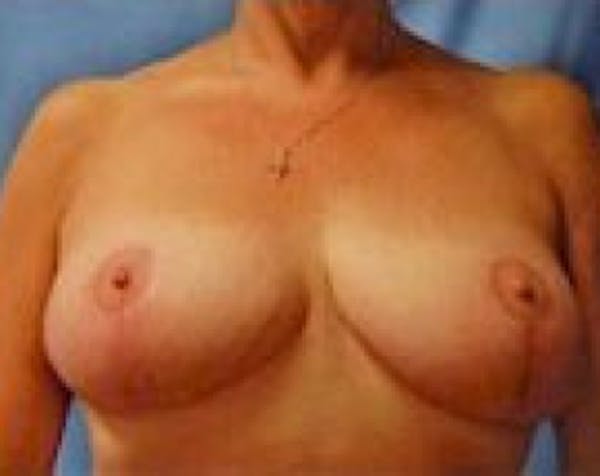 Breast Lift and Reduction Before & After Gallery - Patient 5950950 - Image 2