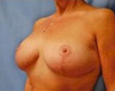 Breast Lift and Reduction Before & After Gallery - Patient 5950950 - Image 4